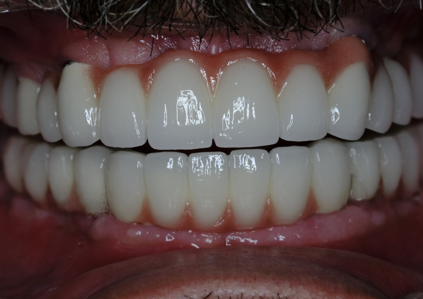 Naxis NX30 Full Mouth - Germany - Naxis