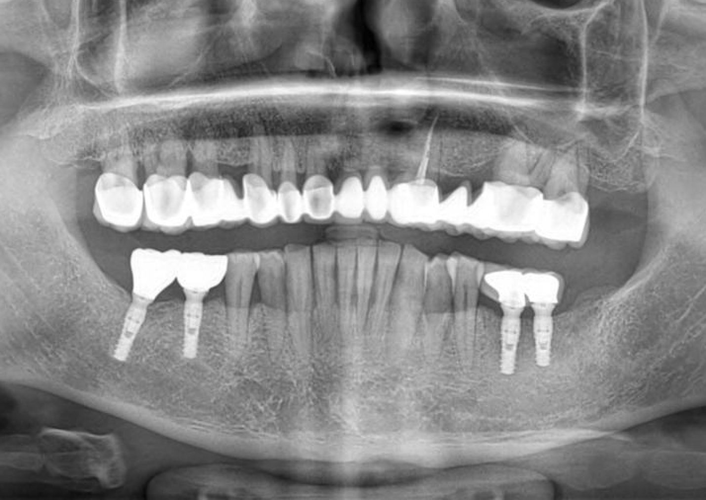 Implant Treatment with Naxis Implants in a Patient with Diabetes and Heavy Smoking-Alcohol Use: A Case Presentation - Romania - Naxis