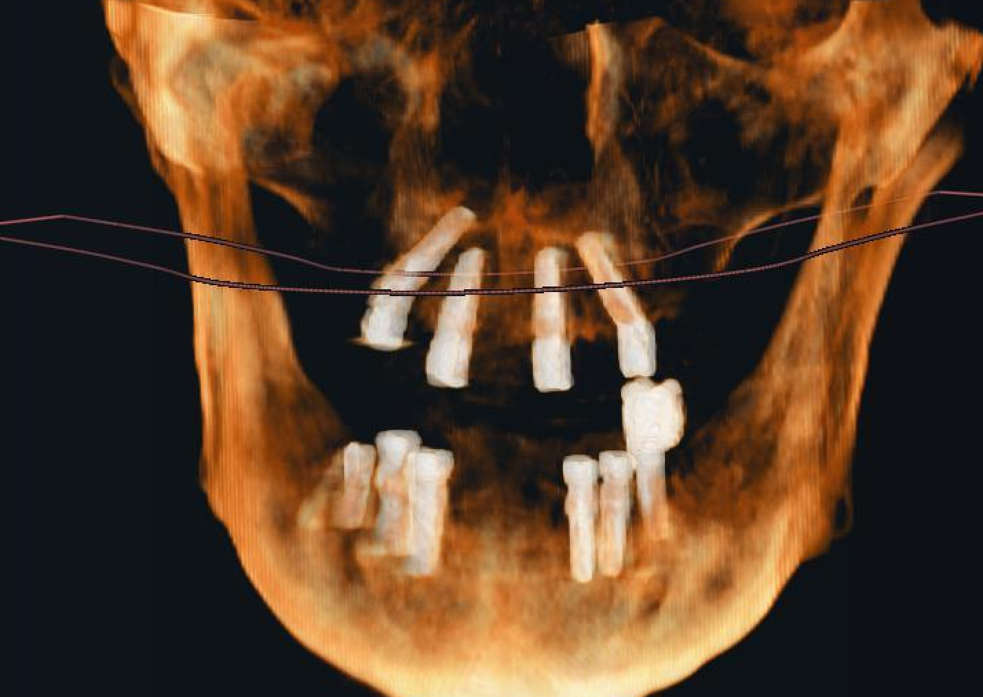 Sinus Avoidance Technique: Placement of 4 Upper Jaw and 6 Lower Jaw Implants - Turkiye - Naxis