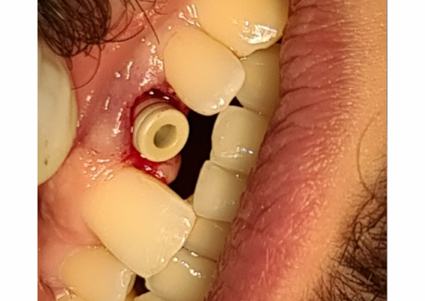 Immediate Loading of Naxis Implant with Simultaneous Restoration - Syria - Naxis